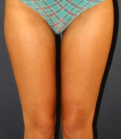 Feel Beautiful - Liposuction Inner Thighs 203 - After Photo